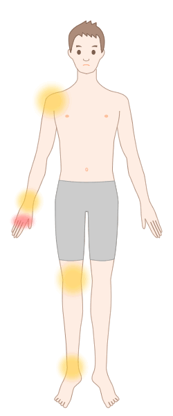 回帰性リウマチで生じる痛みの部位