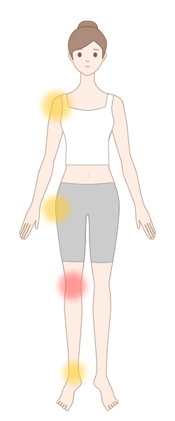 化膿性関節炎で生じる痛みの部位（※赤丸は主な関節痛の部位） 