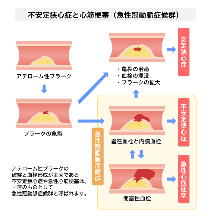 急な胸の痛み（胸痛発作）