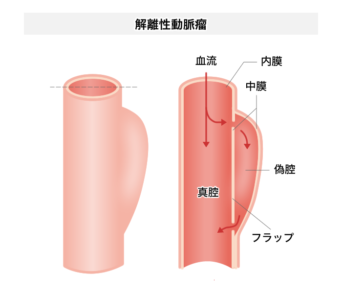 解離性大動脈瘤