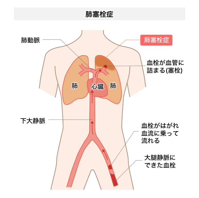 肺塞栓症