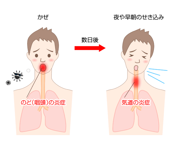 咳 我慢 すると どうなる