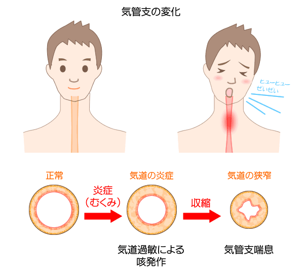 息 を 吐く 時に 咳 が 出る