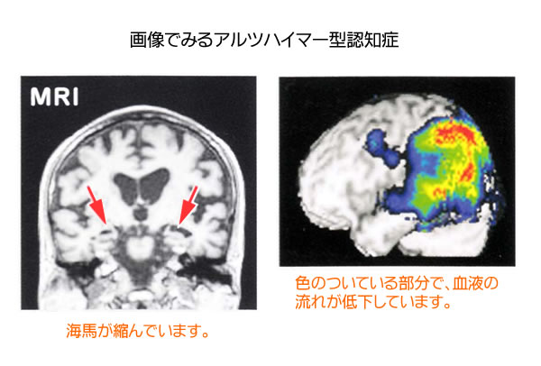 画像でみるアルツハイマー型認知症