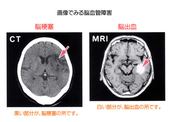 画像でみる脳血管障害