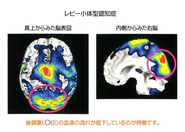 レビー小体型認知症