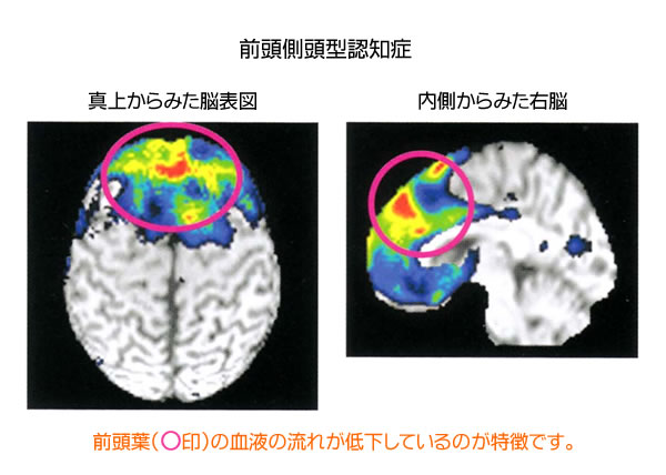 前頭側頭型認知症