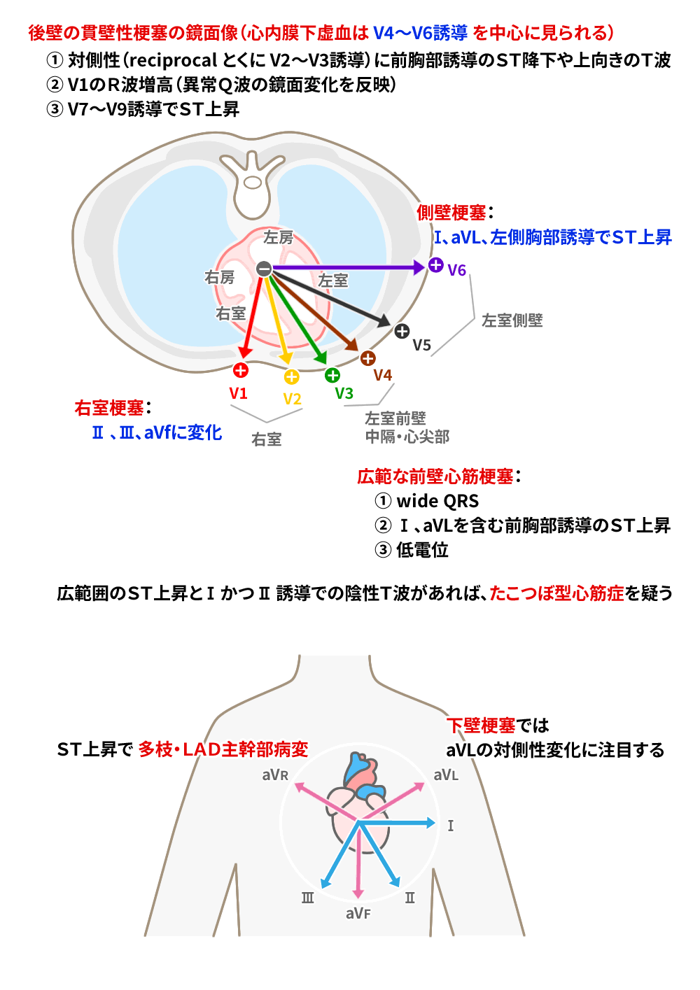 急性冠症候群ACSと心電図