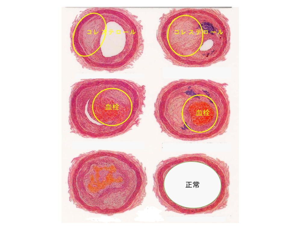 動脈硬化の血管断面
