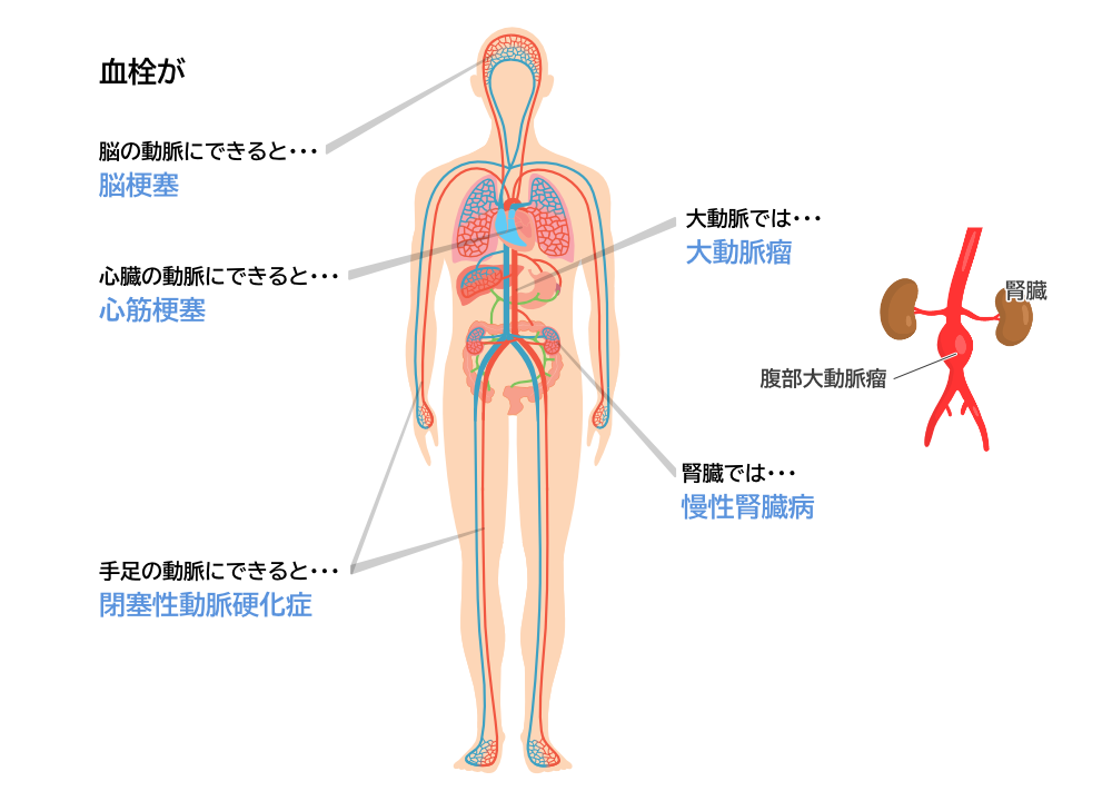 動脈硬化が原因で起こる病気