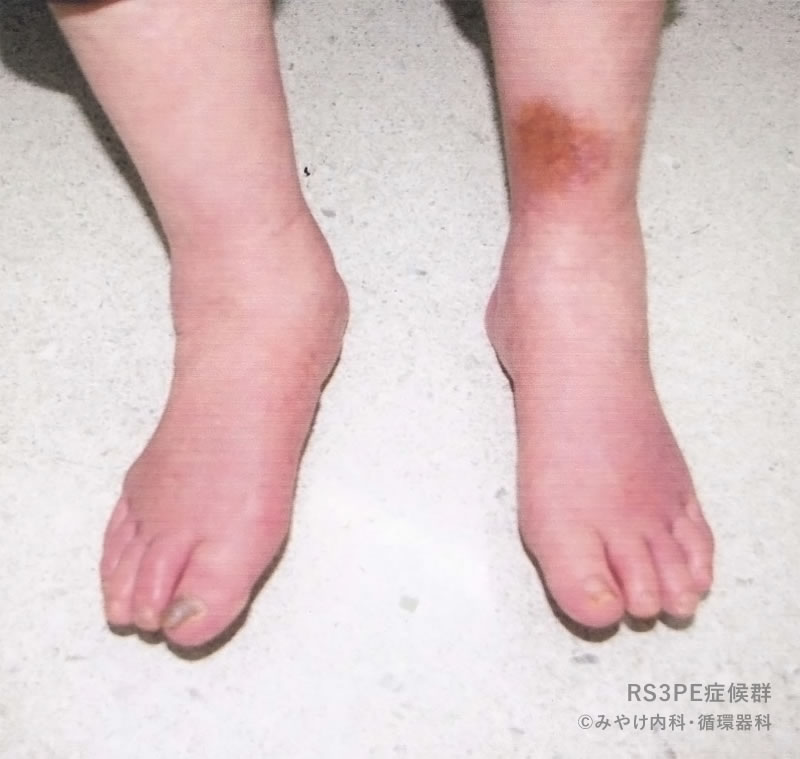 RS3PE症候群：自験例の足趾の浮腫