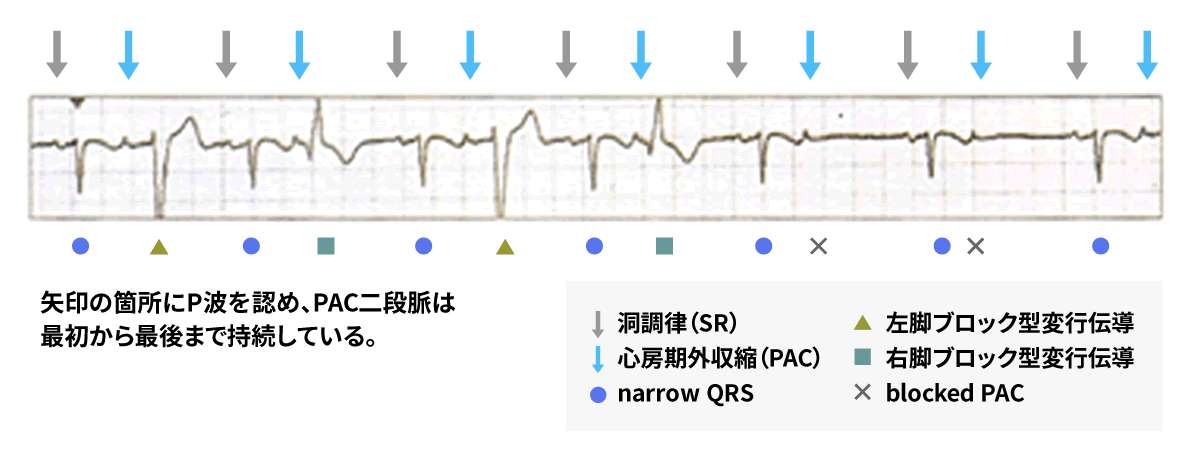 不整脈の見通しはどうなりますか?