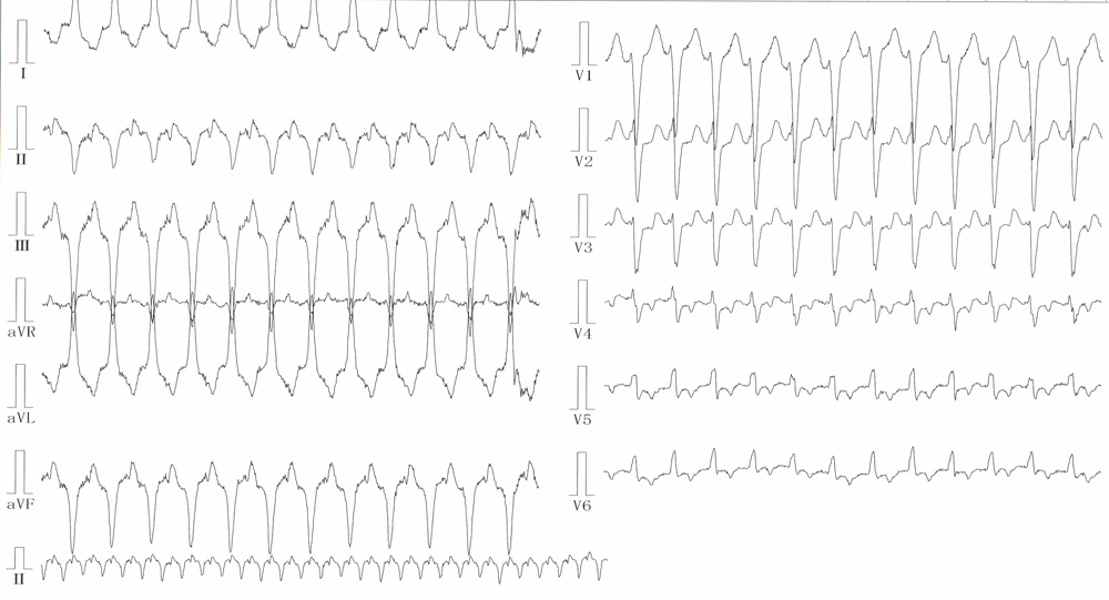 不整脈原性右室心筋症の心電図